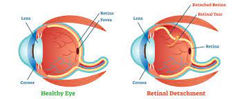 The best websites voted by users. Retinal Detachment Surgery In Delhi Cost Treatment Best Surgeon
