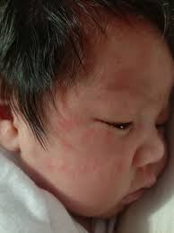 Advice pls😘 Mga mommies anu po kaya tong nasa mukha ng baby