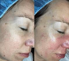 Get Glowing: Hydrafacial Q&A with Dermatology Affliates