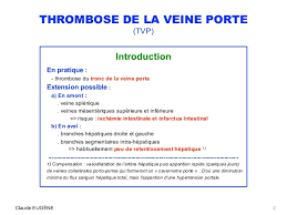 Thrombose De La Veine Porte Causes Signes Diagnostic Traitement