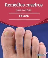 Calo Seco No Dedo Do Pé Pin On Dicas