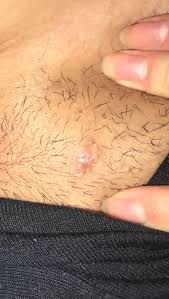 An ingrown hair can also occur in straight hairs areas where there are skin folds or scars, which may increase the likelihood of the hairs penetrating the skin. Ingrown Hair Cyst On Pubic Area Been There For About A Year Now And Have No Idea What To Do Popping