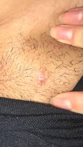 Although possible, it is rare to have ingrown hairs all over the body. Ingrown Hair Cyst On Pubic Area Been There For About A Year Now And Have No Idea What To Do Popping