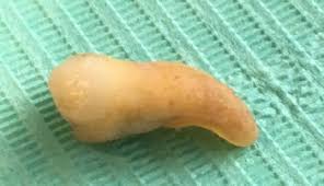 What to eat, how to ease the pain, help you sleep, tasty tooth fairy series: Symptoms Of Wisdom Teeth What To Look For What To Do