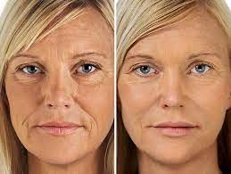 Maybe you would like to learn more about one of these? Aquagold Microneedling With Prp