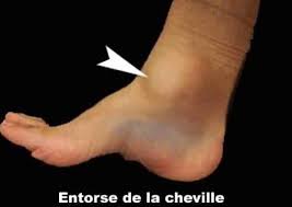 Environ 6000 cas par jour d'entorse de cheville sont recensés en france. Entorse De La Cheville Que Faire Quand C Est A Repetition U Trail