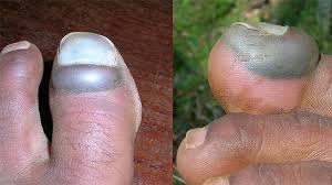 To relieve pressure and pain, your doctor may perform something called nail trephination. Subungual Hematoma Causes Symptoms Pictures Treatment And More