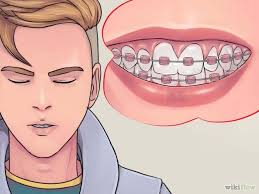 How to reduce braces pain wikihow. Pin On Useful Websites For Braces