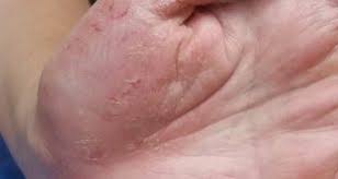 Image result for dermatitis contacta allergica
