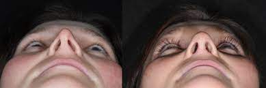 Oft schafft schon olivenöl abhilfe: Fachartikel Hno Wenn Die Nase Zum Chronischen Problem Wird Klinik Pyramide