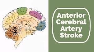 It passes forward and medialward across the anterior perforated substance, above the optic nerve, to the commencement of longitudinal fissure. Anterior Cerebral Artery Stroke Youtube