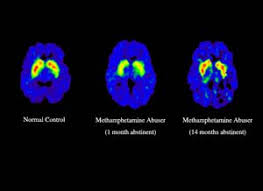 Meth In The Body Meth And The Brain The Meth Epidemic