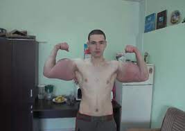 .up muscle, they also sometimes inject other substances, including natural oils — like sesame oil in an earlier case , a bodybuilder in germany who injected sesame seed oil into his muscles for. Russian Injects Oil Into Muscles Shows Off Hulk Like Arms Health News Asiaone