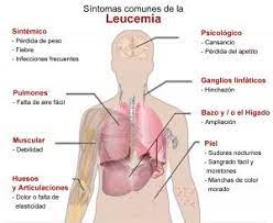 Cuáles son los síntomas, diagnóstico, tratamientos más comunes y tasas de supervivencia. Leucemia Megalabs