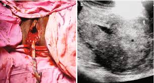 Image result for Retained Placenta