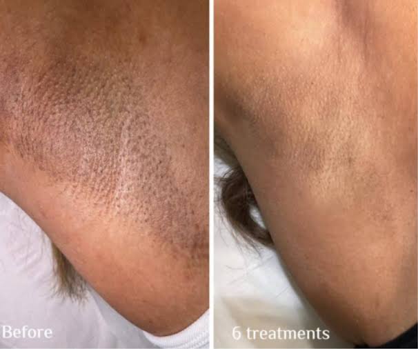 XERF Skin Tightening Treatment: Benefits, Cost & Results