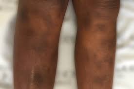 Image result for liver spots on legs
