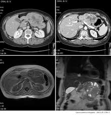 Lansom j., alzahrani n., liauw w., morris d.l. Tumor Carcinoide Hepatico Primario Una Localizacion Inusual Gastroenterologia Y Hepatologia