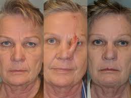 But it was deep and located right on her nostril. Basal Cell Skin Cancer Of The Nose Rebuilt With A Forehead Flickr
