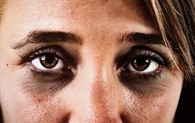 Dark Eye Circles How To Remove Them Permanently