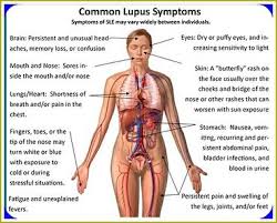 Lupus Facts A Big Part Of Lupus Includes Swelling Many Times The Swelling Is Linked To Lupus Nephritis A Kidney Complica Lupus Facts Lupus Symptoms Lupus