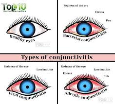 Home Remedies For Conjunctivitis Pink Eye In Children Pink Eye In Children Pink Eye Home Remedies Pinkeye Remedies