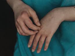 Image result for scabies effects on the human body