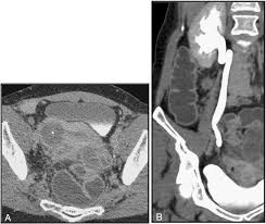 Multislice computed tomography with colon water distension (MSCT-c) in the  study of intestinal and ureteral endometriosis