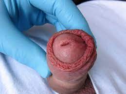 Balanitis Vorhaut Problem An Der Eichel Online Diagnose Therapie