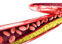 Man erhofft sich durch diese nur 2x im jahr notwendige selbstinjektion eine geringere abbruchrate. Hypercholesterinamie Erhohte Cholesterinwerte Ihre Apotheke