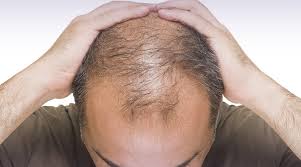 Quali sono le cause della perdita dei capelli? Perdita Capelli Uomini Rimedi Stempiature E Diratamenti Uomini