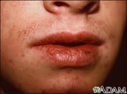 Scc tumors are commonly found on body parts with frequent sun exposure, such as the face, ears, neck, lips, and back of the hand or. Squamous Cell Skin Cancer Information Mount Sinai New York