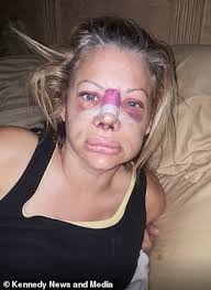 Mother claims she has been left with 'Barbie lips and a piggy snout' after  five 'botched' surgeries