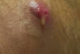 Bot flies, aka torsalo or dermatobia hominis. Human Bot Fly Removal Video