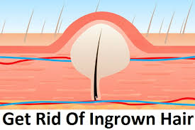 Warm soaks are helpful and soothing, dr. 12 Ways To Get Rid Of Ingrown Pubic Hair Naturally Home Remedies Blog