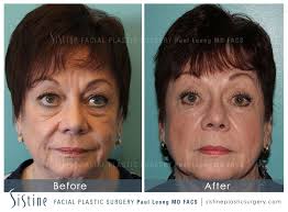 Browse sculptra aesthetic before & after photos shared by doctors on realself. Sculptra Before And After 01 Sistine Facial Plastic Surgery