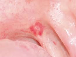 Image result for Erythroplakia roof of mouth