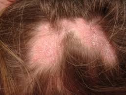 •hydroxychloroquine (plaquenil) is the most commonly prescribed because it is generally believed to cause fewer side effects of them all. Lichen Planopilaris Dermnet Nz