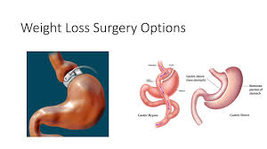 Both had to go through rigorous interviews and counselling at the sgh lifestyle improvement and fitness. How To Restart Weight Loss After Gastric Bypass With Five Day Bariatric Diet Youtube