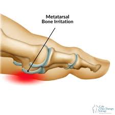 Image result for Metatarsal