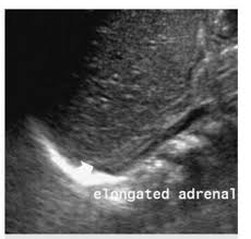 The Lying Down Adrenal Gland Arrow Seen With Ipsilateral Renal Agenesis Renal Adrenal Glands Adrenals