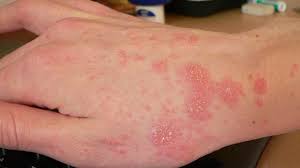 Illustration of hand, infected scabies and scabies mite scabies (sarcoptes scabies) scabies is an infestation, not an infection. Scabies Vs Eczema Differences Symptoms And Treatment