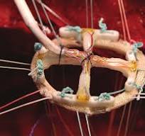 Mitral annular force transducer prior to insertion, pre ...
