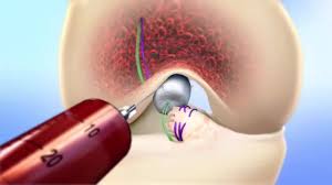 New knee repair surgery