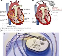 An icd does everything a pacemaker does, and a little bit more. Cardiovascular Medical Devices Heart Valves Pacemakers And Defibrillators Mechanical Circulatory Support And Other Intracardiac Devices Sciencedirect