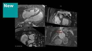 Image result for Cardiac MRI