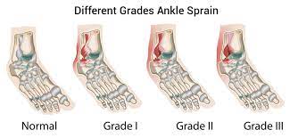 The rehabilitation guidelines for a grade 2 lateral ligament sprain can be split into 4 phases: The Sprained Ankle What Does It Mean Flexed