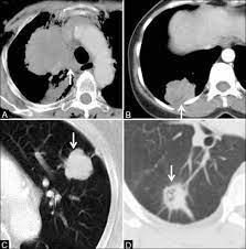 A ct scan is used to: Lung Cancer Ct Wikidoc