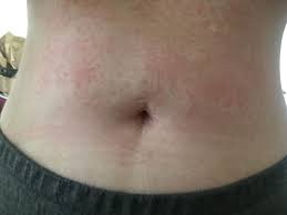 Keto Rash Keto Rash Keto Jesus Fish Tattoo