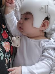 Craniosynostosis Symptoms